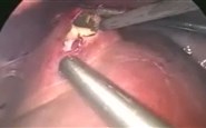 laparoscopic management of Hydatid cyst liver