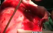 Surgical Removal of Hydatid cyst of brain